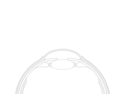 Zdravljenje keratokonusa z metodo Crosslinking.