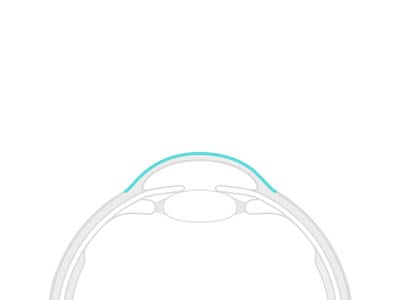 Zdravljenje keratokonusa z metodo Crosslinking