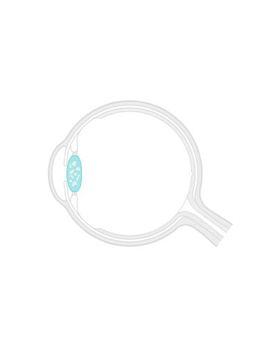 Shematski prikaz očesa s sivo mreno